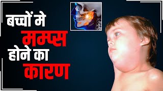 Mumps In Children Prevention Tips बच्चों में मम्प्स की समस्या का ये है कारण जानें बचाव का तरीका [upl. by Kries]