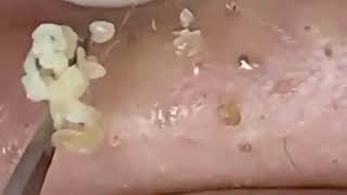 new blackheads this week 2023 [upl. by Ylatan187]