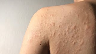 Urticaria symptoms and treatment in Hindi  Urticaria kya hai [upl. by Adalia81]