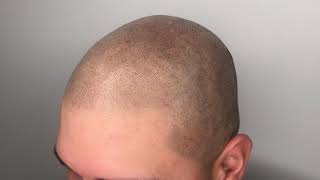 Scalp Micropigmentation after laser tattoo removal [upl. by Aleiram]