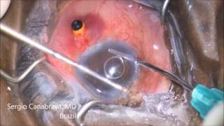 Anterior Vitrectomy in Posterior Capsular Rupture  By Dr Sergio Canabrava [upl. by Lillian888]