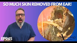 SO MUCH SKIN REMOVED FROM PATIENTS EAR CANAL  EP945 [upl. by Leund34]