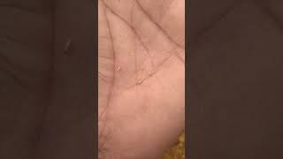 Intestinal myiasis must watch [upl. by Halette]