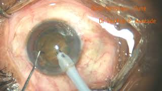 Phaco  Stop amp Chop  Multifocal IOL  Intravitreal Tricort Injection  040624 [upl. by Roderic620]