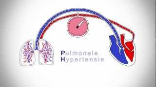 Pulmonale Hypertensie wat is dat [upl. by Rachael]