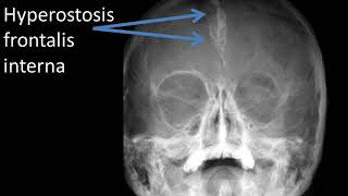 CASE 387 SKULL Hyperostosis frontalis interna [upl. by Vale]