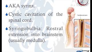 Syringomyelia Part 1 تكيس النخاع الشوكي [upl. by Habas679]