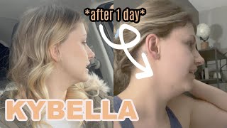 TRYING KYBELLA Process amp Day 1 Swelling  369 [upl. by Bobbette207]