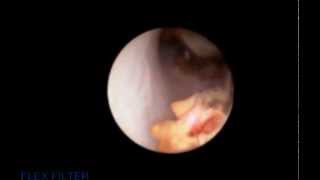 Ureteroscopy and laser fragmentation of stone [upl. by Rainah952]