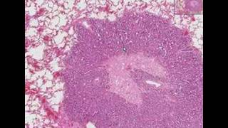 Histopathology LungMetastatic adenocarcinoma [upl. by Nnyrat714]