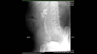 CASE REVIEW intravenous pyelography IVP [upl. by Nolyarb]