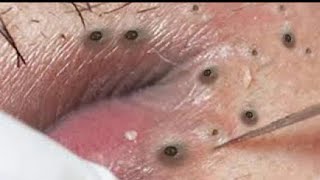 How To Removal Blackhead On lip Blackhead Acne Treatment24 [upl. by Franciscka100]