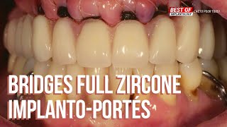 Les bridges full zircone implantoportés  Implantsupported full zirconia bridges [upl. by Ho]