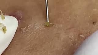 blackheads new this week  popping pimple asmr  blackheads and whiteheads removal [upl. by Augusto]