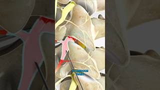 Selective nerve root block 3D Animation [upl. by Suoirad]