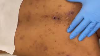 34 Old Blackhead Removal blackheads 2023 new this week [upl. by Orpha101]