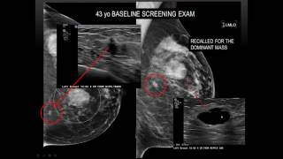 2017 AOCR Radiology Case Review Bread and Butter of Breast Imaging  Essentials Tips amp Pearls [upl. by Trainor]