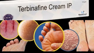 terbinafine hydrochloride creamuseside effecthow to use terbinafine cream nepali [upl. by Alor901]