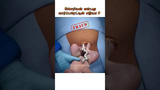 சிசேரியன் என்பது கார்ப்பரேட்டின் சதியா  Is Caesarean procedure a scam Dr Isacc Abbas [upl. by Iggie855]