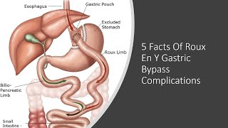 5 Facts Of Roux En Y Gastric Bypass Complications [upl. by Ayalat84]