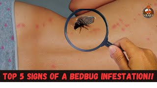 Top 5 signs of a bedbug infestation [upl. by Rivy738]