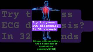 ecgdiagnosis hypothyroid hypothyroidism cardiology ecganalysis [upl. by Ennovaj]