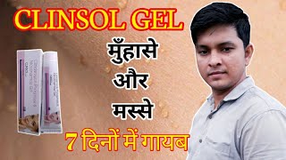 Clinsol gel Use and its side effects  Clinsol gel cream for pimple and wats use in hindi [upl. by Trici731]