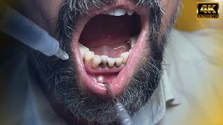 “Is Pulling a Tooth That Easy Dentist Explains in 1 Minute” Subtitled [upl. by Woodrow398]