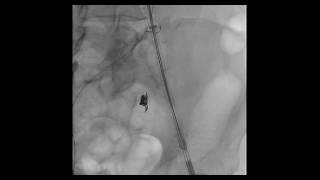 IMPLANTE DE ENDOPROTESIS AORFIX [upl. by Evers]