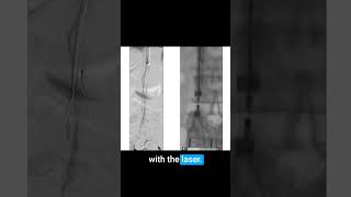 Quick Guide to Laser Sheath for Filter Retrieval with Dr Noor Ahmad medicaleducation [upl. by Isaac]