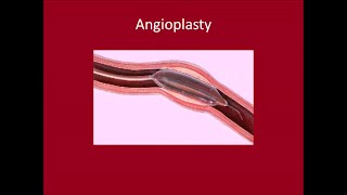 Angioplasty [upl. by Acissev]