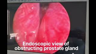 Transurethral Resection of Prostate TURP for Obstructing prostate gland [upl. by Dominique]