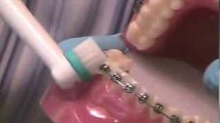 Brushing Braces with an ElectricToothbrush [upl. by Hudnut]