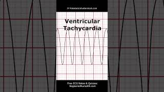 ECG EKG Heart Rhythms POP Quiz Can You Identify These Heart Rhythms shorts ecg nursing [upl. by Iad]