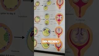 dizygotic and monozygotic definition for TWINS Pregnancy 😳😍 [upl. by Arleyne]