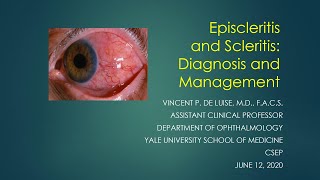 Scleritis and Episcleritis Vincent de Luise MD [upl. by Hamirak]