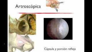 Anatomia Quirúrgica de la Cadera [upl. by Novart70]