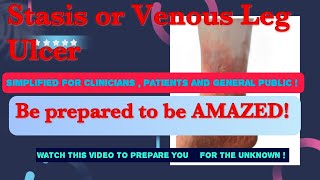 Venous Leg Ulcer Stasis Ulcer  Understanding the cause  treatment and selfmanagement [upl. by Joella361]