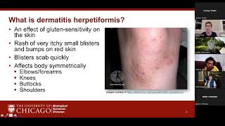 Dinner with the Doctor  Dermatitis Herpetiformis [upl. by Lisk81]