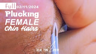 Satisfying Plucking Female Facial Hairs with Tweezers  PCOS Hair Removal [upl. by Addam]