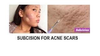 Acne scar treatment Subcision and TCA cross [upl. by Cesaro]