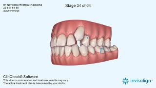 Aparat ortodontyczny Invisalign  wizualizacja leczenia dr Weronika WieruszHajdacka [upl. by Ivetts]