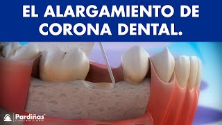 Alargamiento de corona dental © [upl. by Charlie]