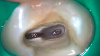 DRendo  Deep partial pulpotomy in a maxillary premolar [upl. by Velleman]