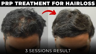 PRP Hair Loss Treatment Results  3 Sessions Result prptreatment [upl. by Beasley492]