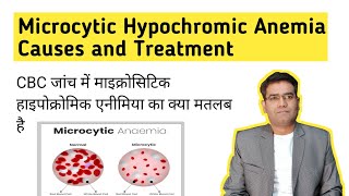 What is Microcytic Hypochromic Anemia its Causes and Treatment in Hindi Iron Deficiency [upl. by Nalla]