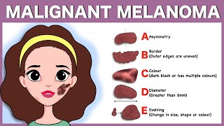 Malignant melanoma Signs Pathophysiology Types Diagnosis Treatment [upl. by Yrolg373]