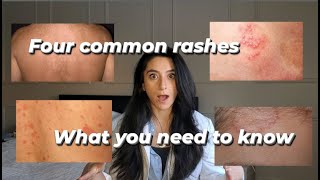 Four common rashes and everything you need to know about them [upl. by Relyuhcs455]