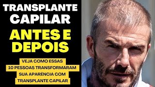 TRANSPLANTE CAPILAR ANTES E DEPOIS 10 PESSOAS QUE MUDARAM INCRIVELMENTE SUA APARÊNCIA [upl. by Ahsimac]