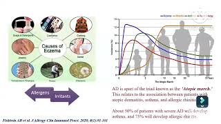 Atopic dermatitis diagnosis amp assessment Prof Ghada Shousha Pediatric immunology amp allergy Ain Shams [upl. by Burger]